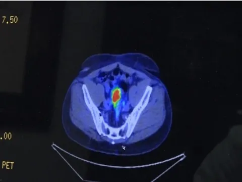 Phòng bệnh ung thư tuyến tiền liệt, cách tốt nhất là gì?