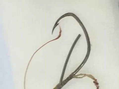 Hy hữu: Ăn cá bị hóc lưỡi câu