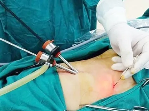 Người phụ nữ mất túi mật vì tự 'bắt bệnh'