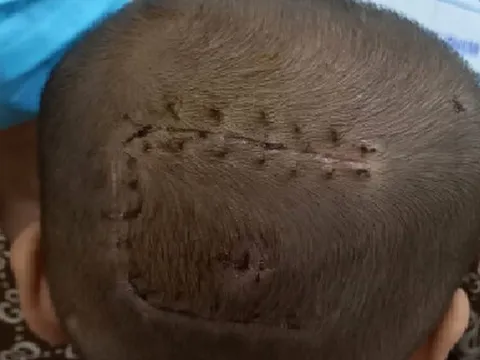 Phẫu thuật thành công khối u màng não cho bệnh nhi nhỏ tuổi