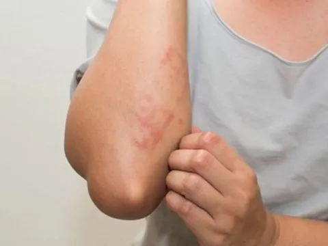 Nhiễm HIV ở nhóm nam quan hệ tình dục đồng giới gia tăng nhanh