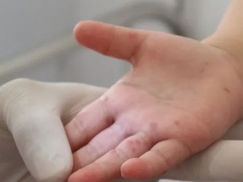 Cách phòng tránh các bệnh truyền nhiễm thường gặp khi giao mùa