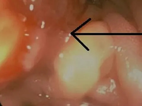 Cứ tưởng đau bụng bình thường, vào viện bé 15 tuổi mới biết mắc ung thư