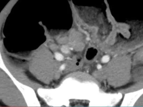 Vào viện khám vì đau bụng, bé trai 15 tuổi phát hiện mắc ung thư đại tràng