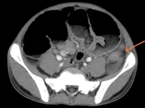 Trẻ 15 tuổi mắc ung thư đại tràng, chuyên gia chỉ cách phòng bệnh