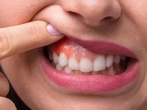 6 triệu chứng ung thư miệng dễ bị bỏ qua