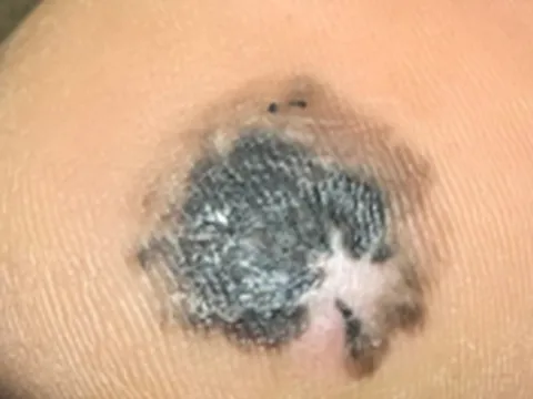 Cẩn trọng với các dấu hiệu cảnh báo ung thư hắc tố