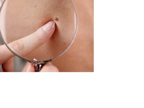 Người phụ nữ phát hiện ung thư từ nốt ruồi có dấu hiệu bất thường