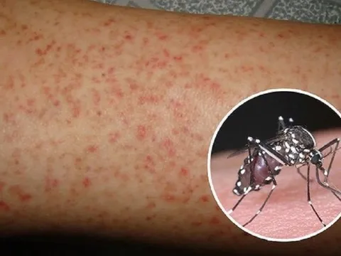 Đắk Lắk chỉ đạo tăng cường phòng, chống bệnh sốt xuất huyết