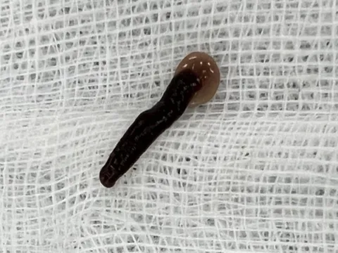 Gắp con đỉa trâu dài 5 cm kí sinh trong mũi người đàn ông