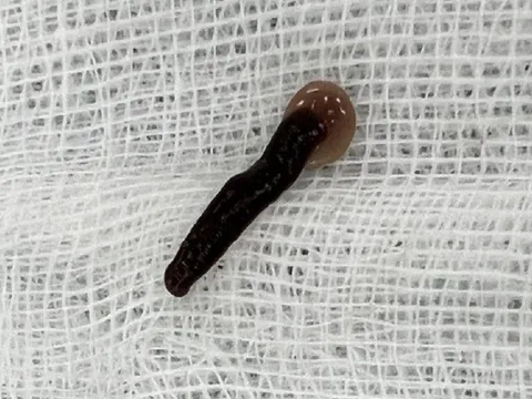 Gắp con đỉa dài 5cm sống trong mũi bệnh nhân
