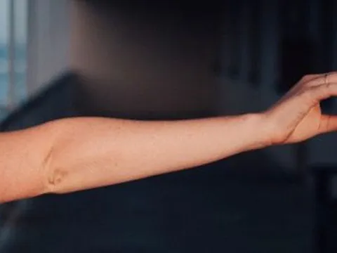 Nghiên cứu mới: Con người tiếp tục phát triển thêm một động mạch giữa trong cánh tay