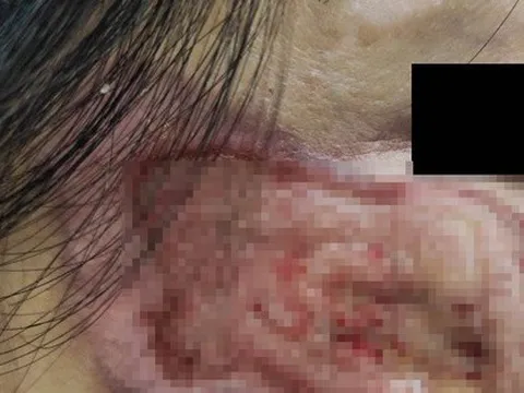 Nhiễm trùng do mua “thuốc chứa axit” để trị nám