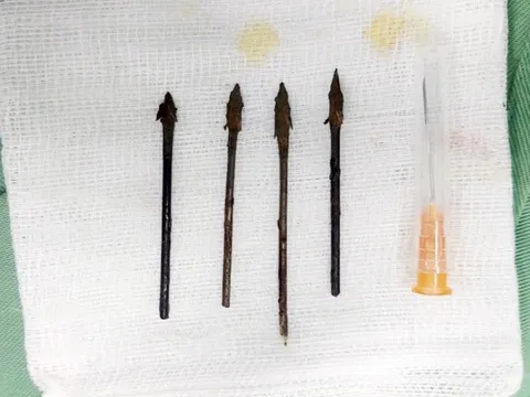 Nghệ An: Nỏ tự chế cướp cò, bé trai 11 tuổi bị mũi tên đâm vào mặt