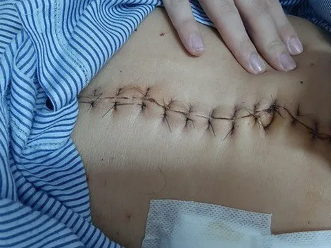 Hai thanh niên bị đâm thủng ruột nguy kịch