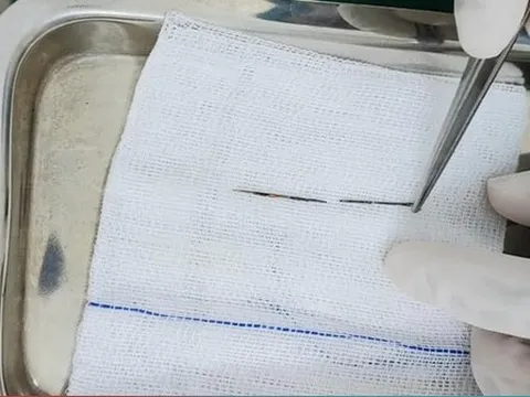 Vào viện khám vì gãy tay, bác sĩ bất ngờ phát hiện kim khâu trong phổi bé trai 4 tuổi