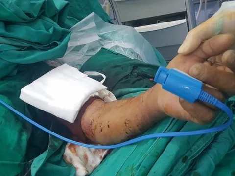 Nối cánh tay đứt lìa cho người đàn ông 50 tuổi