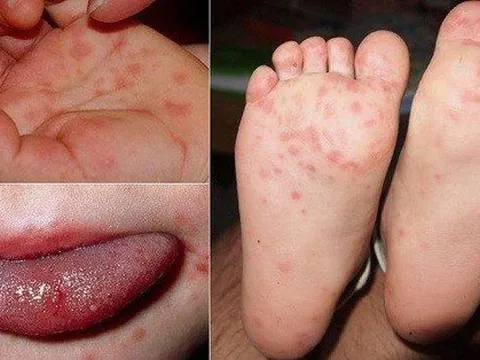 Cuối năm trẻ mắc bệnh tay chân miệng tăng