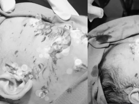 Bé 28 tháng tuổi bị chó cắn gây tổn thương nghiêm trọng vùng mặt