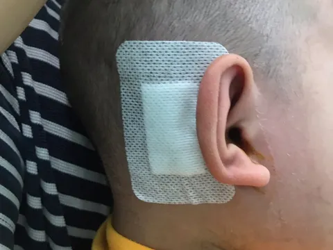 Bé trai điếc bẩm sinh nghe được nhờ cấy ốc tai