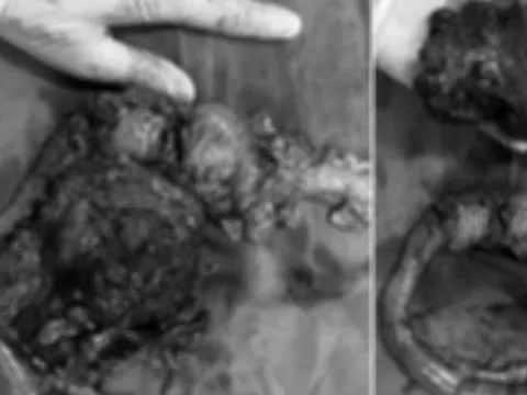 Uống thuốc nam không rõ nguồn gốc, u ác sau phúc mạc to nhanh và xâm lấn phức tạp