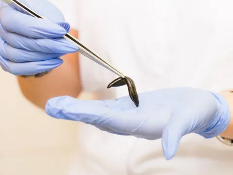 Công dụng từ liệu pháp dùng đỉa hút máu