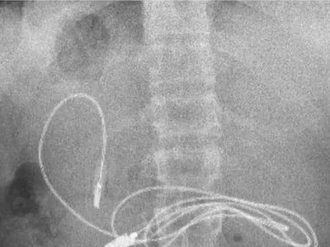 Đau bụng dữ dội vì dây sạc và chun buộc tóc trong dạ dày