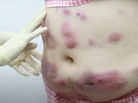 Tin lời quảng cáo làm đẹp trên Facebook, ổ mủ xuất hiện đầy bụng