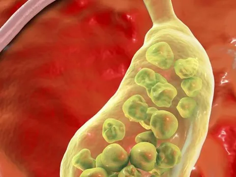 Chỉ đau lưng, người phụ nữ bất ngờ khi đi khám bác sĩ gắp ra 382 viên sỏi