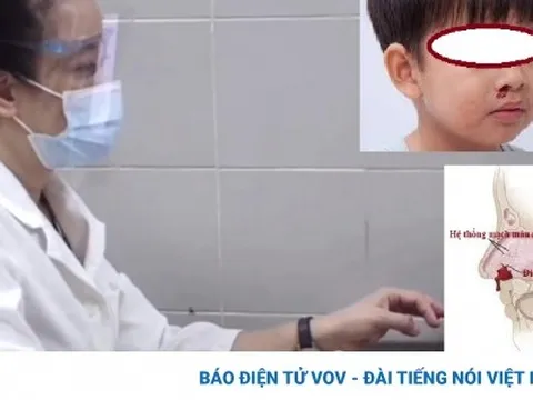 Chảy máu cam mùa đông, có nên lo lắng hay không?