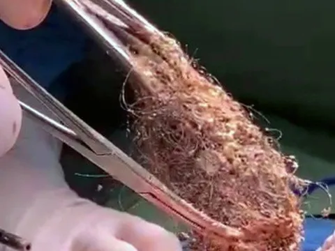 Lấy búi tóc to như banh tennis khỏi dạ dày bé gái ba tuổi mắc hội chứng ăn tóc