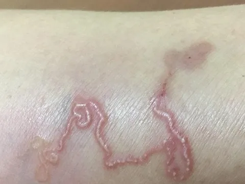 Bệnh ấu trùng da di chuyển là gì?