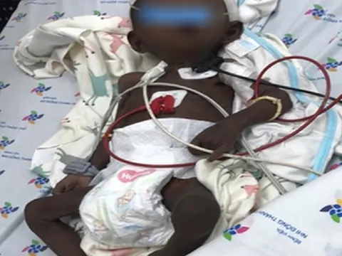 Bé sơ sinh da sạm đen vì bệnh hiếm gặp