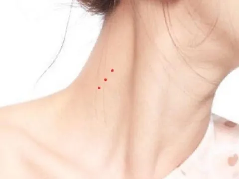 Cần đi khám ngay nếu thấy 'nốt ruồi đỏ” xuất hiện bất thường