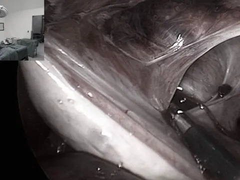 Đau bụng dữ dội, tắc ruột vì nguyên nhân phụ nữ thường gặp sau sinh mổ