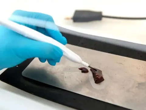 Đột phá: "iDao" có thể phát hiện ung thư trong vài giây