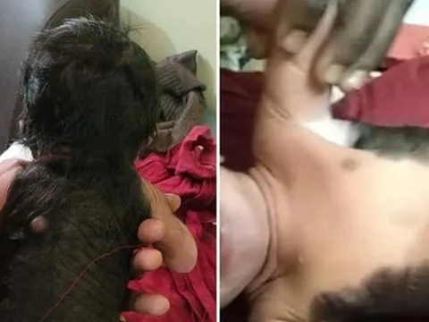 Kỳ lạ cậu bé sinh ra đã có lông, tóc khắp nửa người