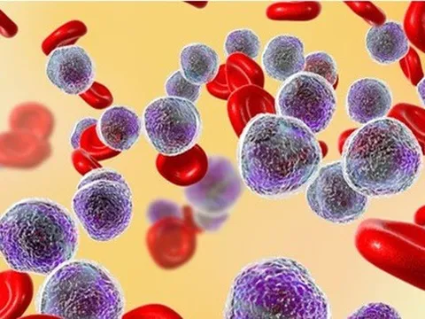 Cẩn trọng trước các dấu hiệu của bệnh bạch cầu