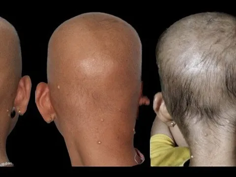 Bé gái 11 tuổi mắc bệnh hiếm, ca đầu tiên trên thế giới