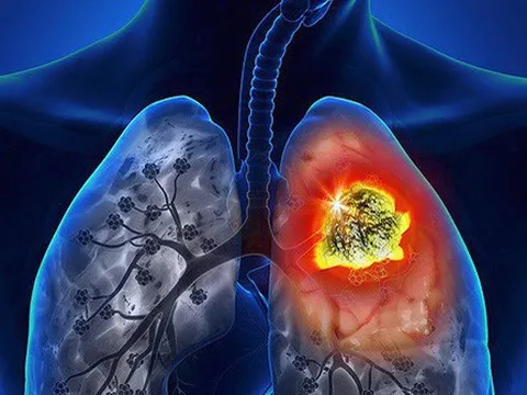 Phát hiện khối u ác tính ở phổi sau thời gian dài bị ho