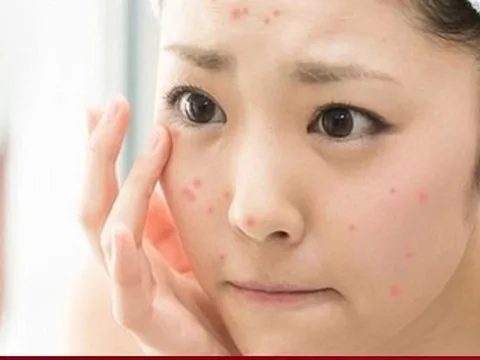Da bị mụn mãi không khỏi, bác sỹ gợi ý cách xử trí hiệu quả để có da đẹp đón Tết