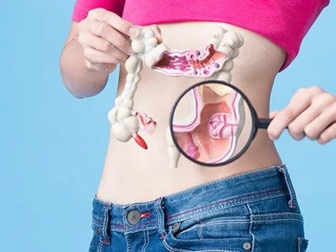 Nhận diện ung thư trực tràng qua những cảnh báo đầu tiên