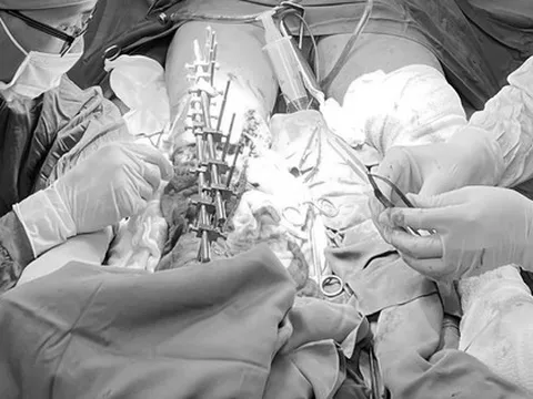 Hi hữu: Cẳng chân người đàn ông bị đứt lìa sau hơn một tuần vẫn nối thành công