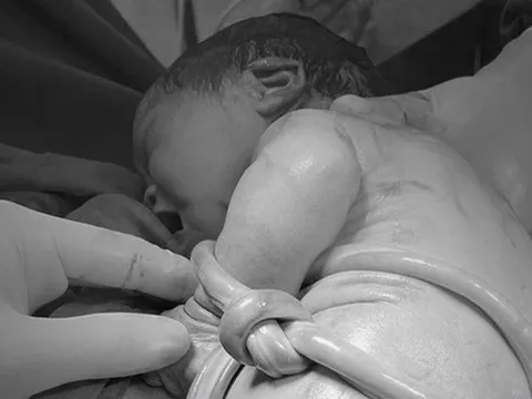 Cấp cứu thành công thai nhi có dây rốn thắt nút nguy hiểm