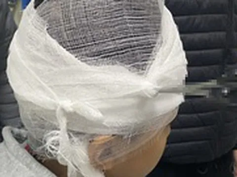 Bé trai bị kéo đâm thủng hộp sọ khi chơi đùa trong lớp