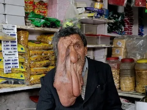 Người đàn ông có bộ mặt chảy xệ lạ kỳ, một căn bệnh hiếm gặp