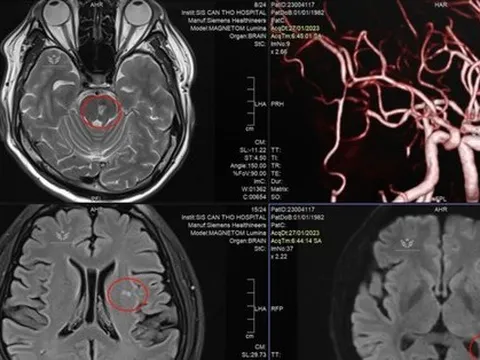 Doanh nhân trẻ đột quỵ vì thường xuyên tiếp đối tác bằng rượu bia