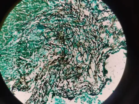 Thời tiết ấm hơn khiến mầm bệnh nhiễm trùng nguy hiểm lan rộng tại Mỹ