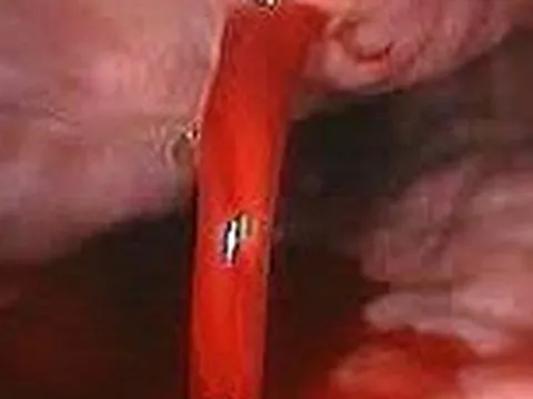 Cấp cứu bệnh nhân nôn ra gần 700ml máu đỏ tươi và cảnh báo của bác sĩ