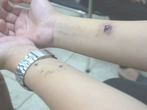 Người đi tiêm vắc-xin phòng bệnh dại tăng chóng mặt